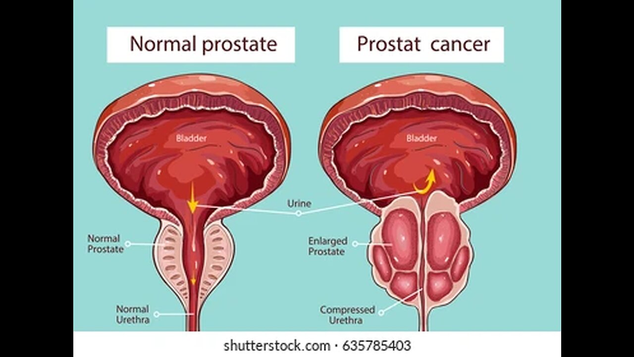 Overactive bladder condition