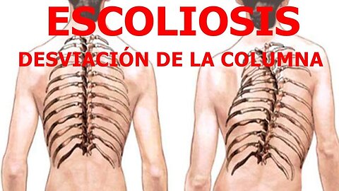 ESCOLIOSIS CAUSAS Y TRATAMIENTO NATURAL BIODESCODIFICACION