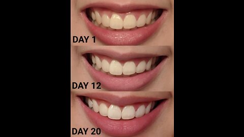Amazing Crest 3D Whitestrips, Professional Effects, Teeth Whitening Strip Kit, 44 Strips (22 Co...