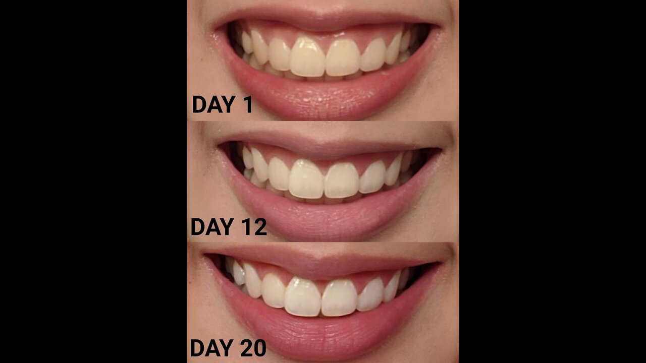 Amazing Crest 3D Whitestrips, Professional Effects, Teeth Whitening Strip Kit, 44 Strips (22 Co...