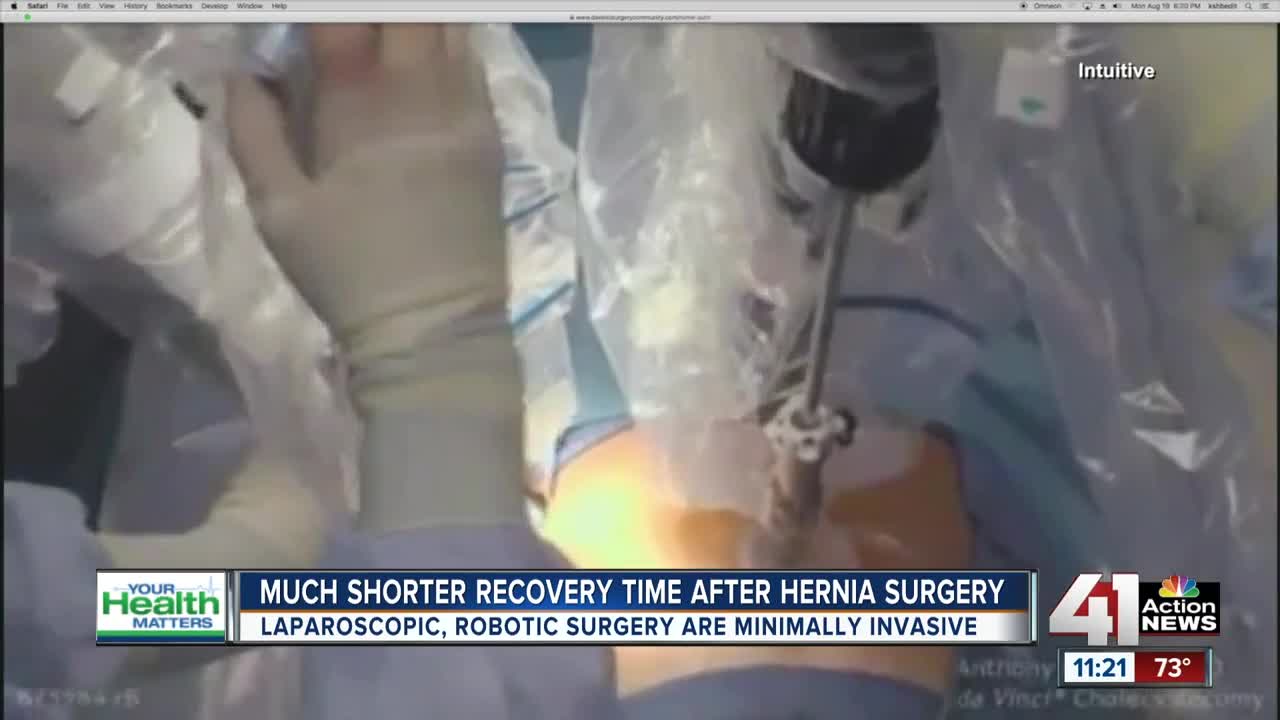 August 22, 2019: Your Health Matters: Shorter recovery time after hernia surgery