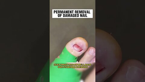 PERMANENT REMOVAL OF FUNGAL NAIL [ DAMAGED NAIL ] BY FAMOUS PODIATRIST MISS FOOT FIXER