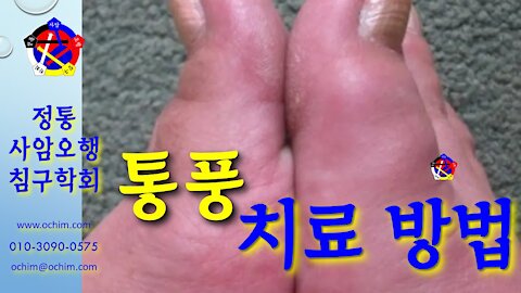 사암침, 사암침법 - 통풍 치료 방법 - 비과학적 양의학 140