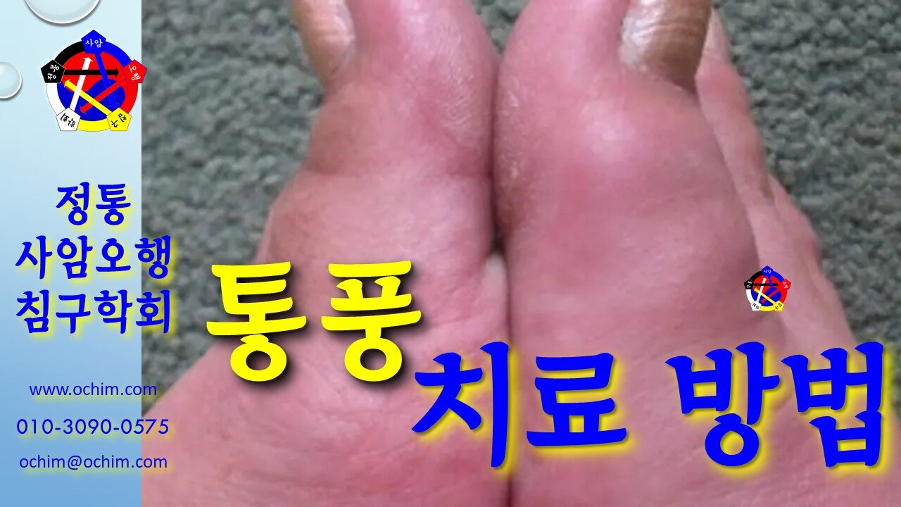 사암침, 사암침법 - 통풍 치료 방법 - 비과학적 양의학 140