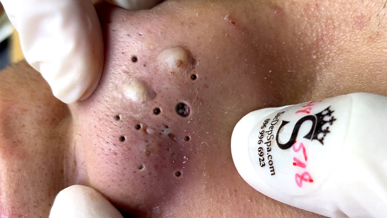 Big Cystic Acne Blackheads Extraction Blackheads & Milia, Whiteheads Removal Pimple Popping