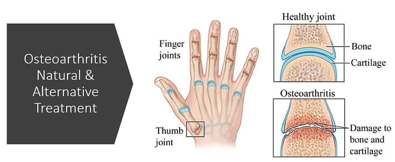 Osteoarthritis - Natural & Alternative Treatment