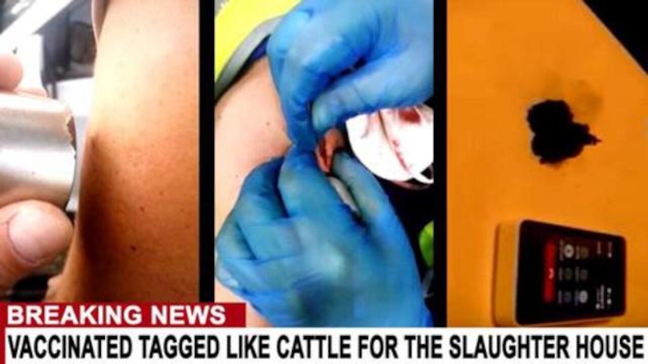 MARK OF THE BEAST IMPLANT REMOVED FROM VACCINATION SITE