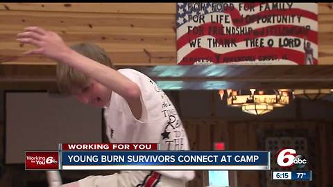 Young burn survivors connect at Indiana camp