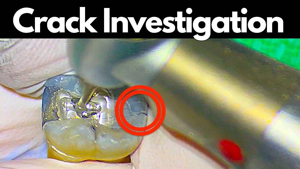 Mandibular Molar Access - Crack Investigation