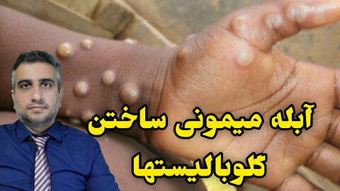 آبله میمونی ساختن گلوبالیستها !!