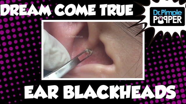 A Compilation of Blackheads in The EARS