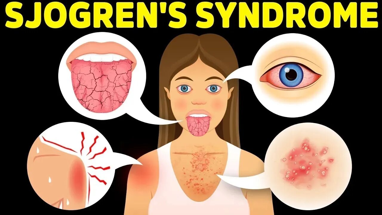 The Best Protocol for Sjogren's Syndrome