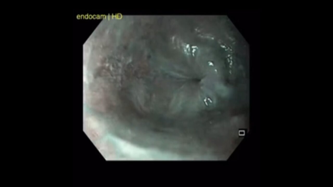 SquamousCellCarcinoma of the Esophagus