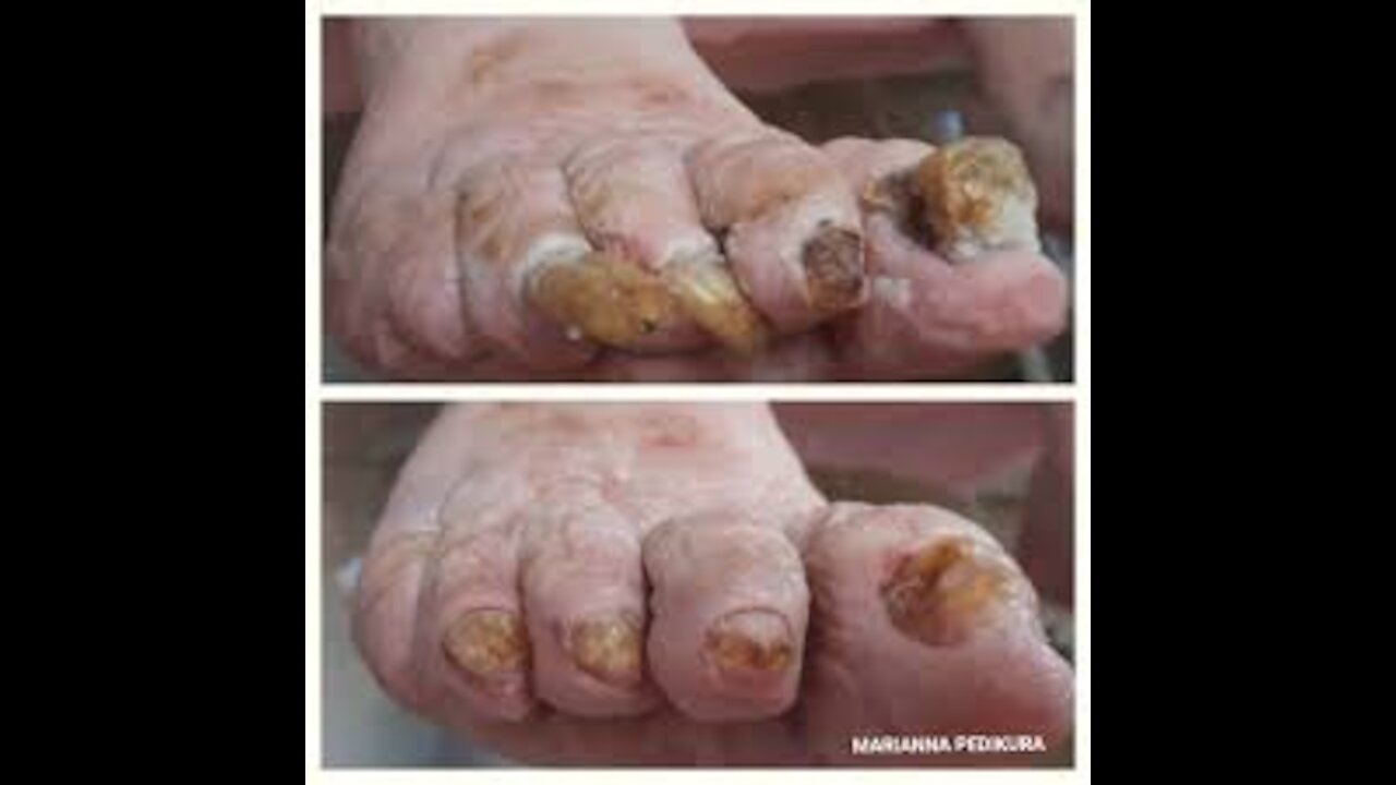 GRINDING DOWN LONG AND THICK NAILS (nail cleaning)