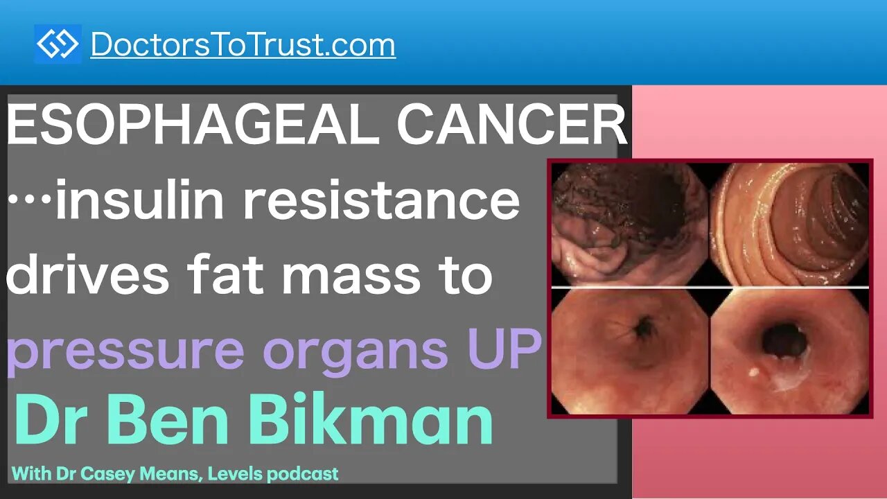 BEN BIKMAN 3 | ESOPHAGEAL CANCER…insulin resistance drives fat mass to pressure organs UPWARD!