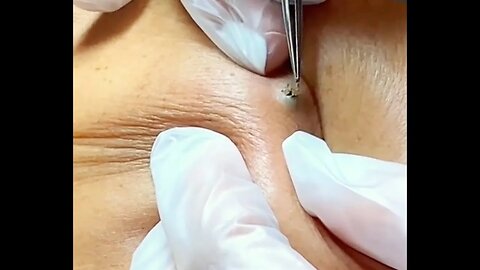 One big blackhead. Pimple popping