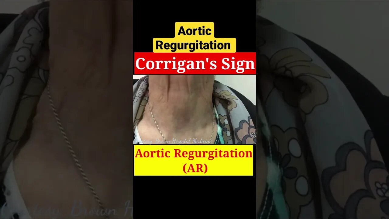 Aortic Regurgitation #shorts #dr #aortic