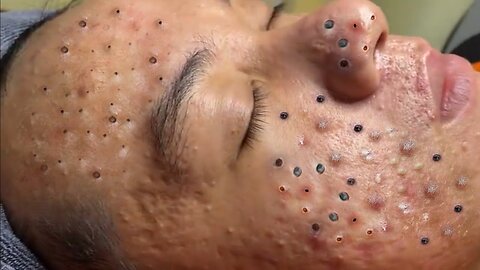 blackhead acen pimple removing