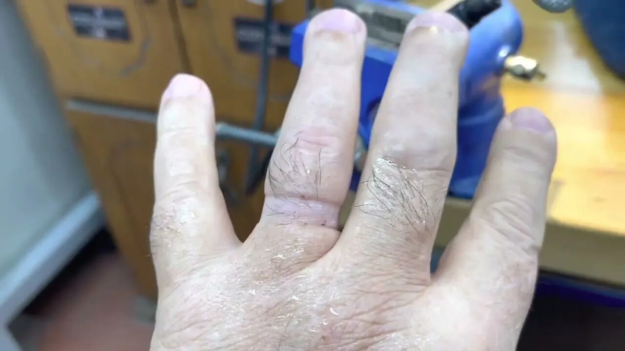 Cutting a ring off my finger