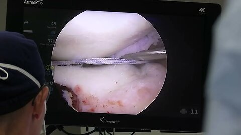 Meniscal Transplant - Scott A. Barbour, M.D.