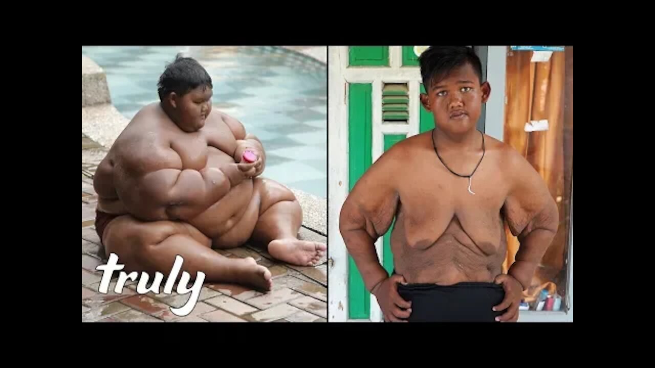 World’s Heaviest Kid' Has Saggy Skin Surgery