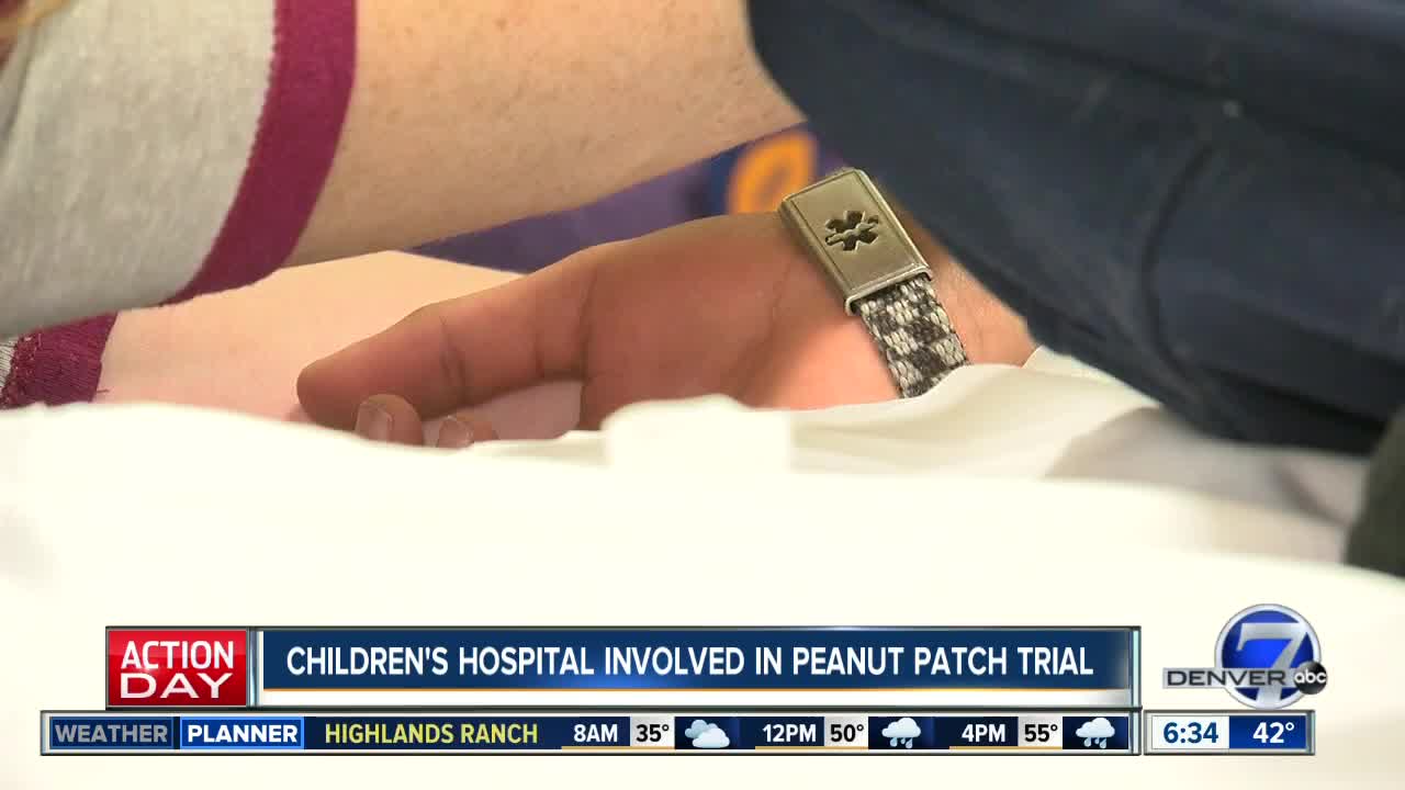 Children's Hospital involved in peanut patch trial