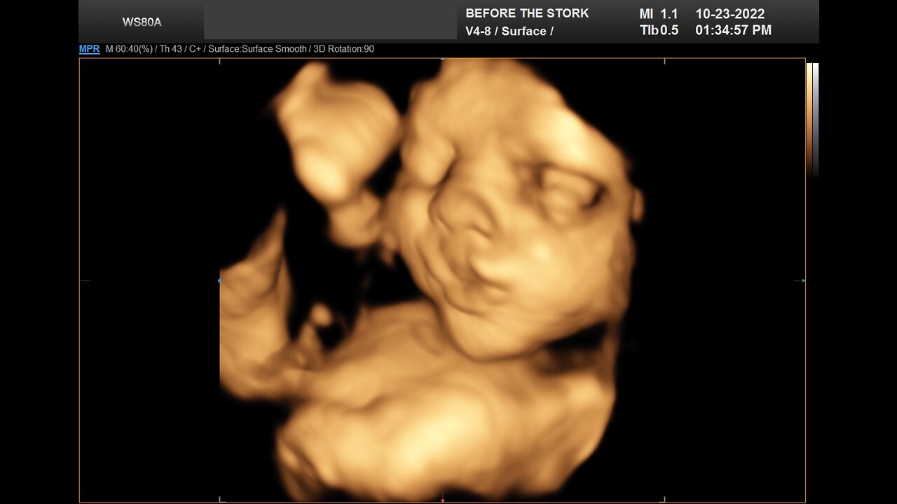 Baby Bush Ultrasound 1