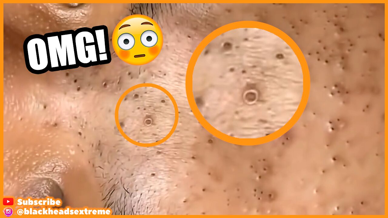 Blackheads Removal On Lady's Face (Oddly Satisfy)