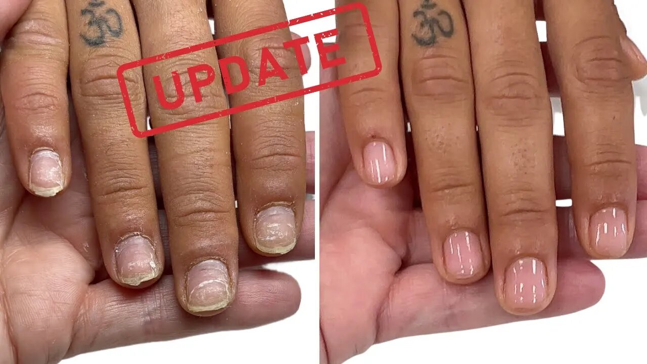 Regrowing bitten nails and acrylic damage [Watch Me Work]