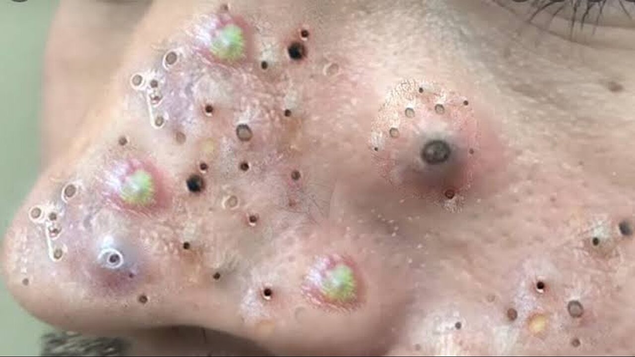 popping Huge Blackheads And Pimple Popping - Satisfying Popping Video