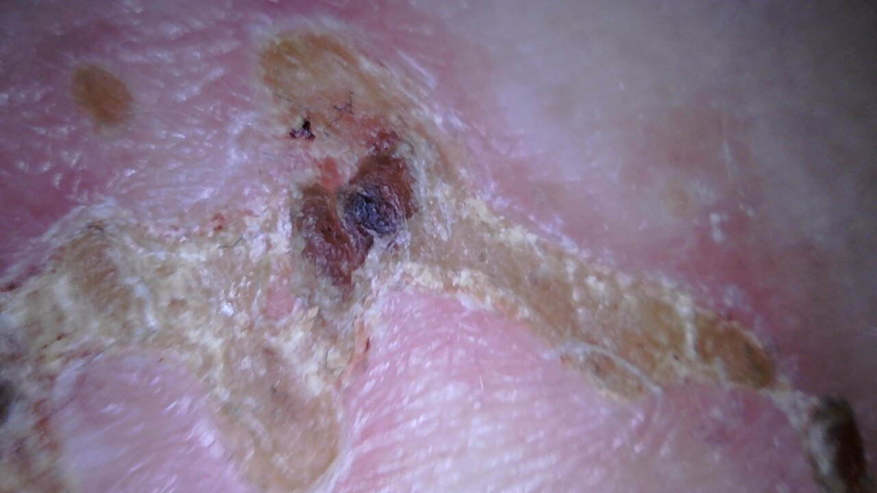 Day 14 Shingles Hookworm 2024-03-24_13-40-52