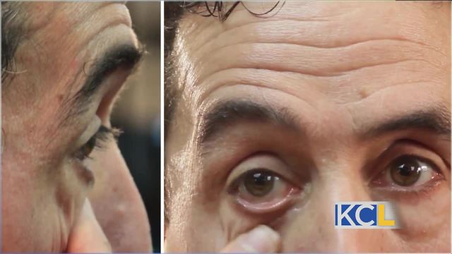 Plexaderm gets rid of under-eye bags and wrinkles