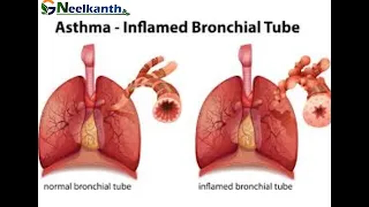 The best medicine for asthma patients will eradicate asthma from its roots.