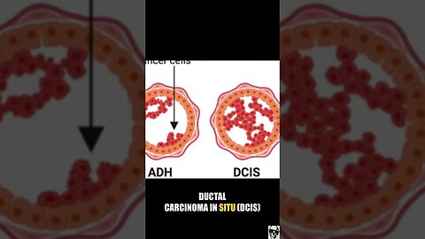 Intro to Breast Cancer