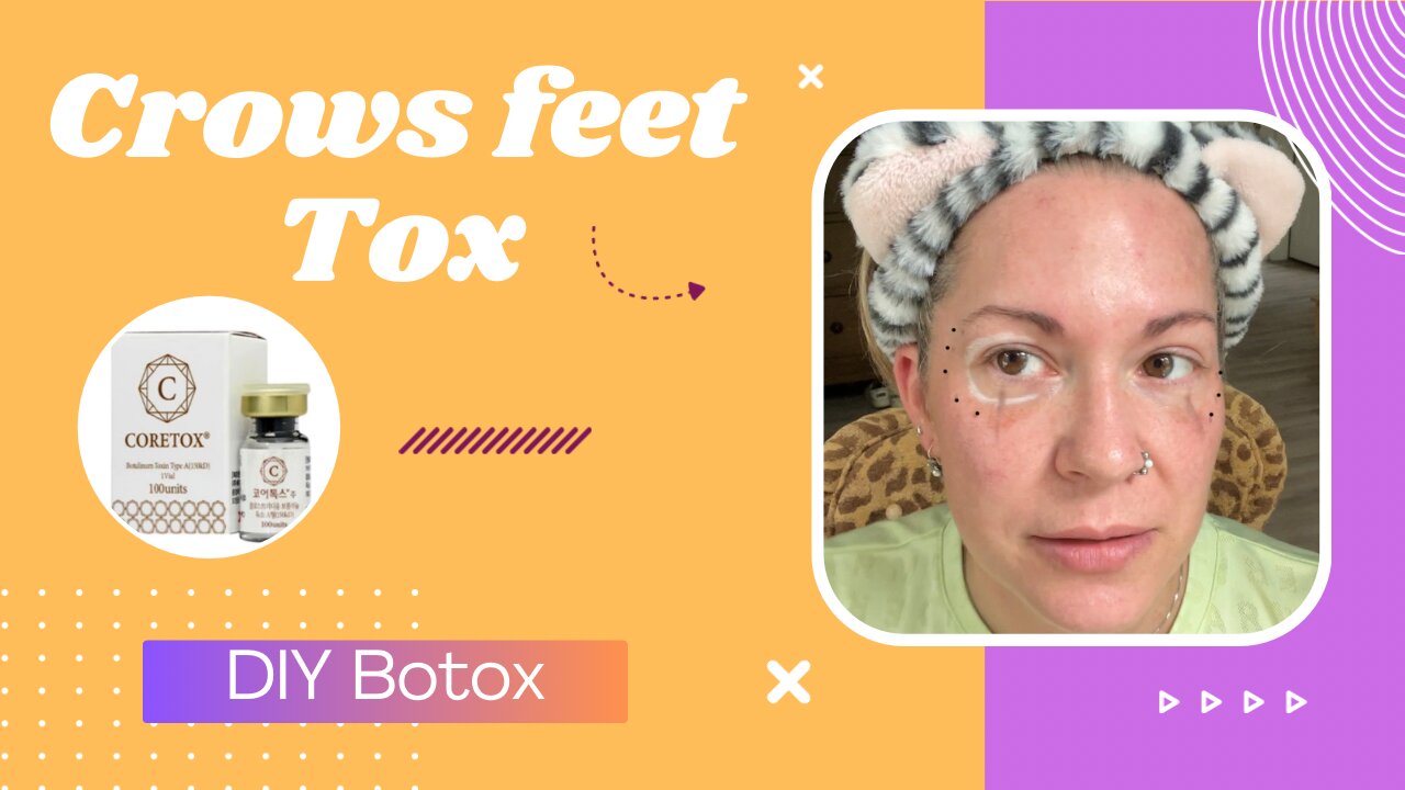 Crows feet | DIY Botox | Coretox vegan Botox