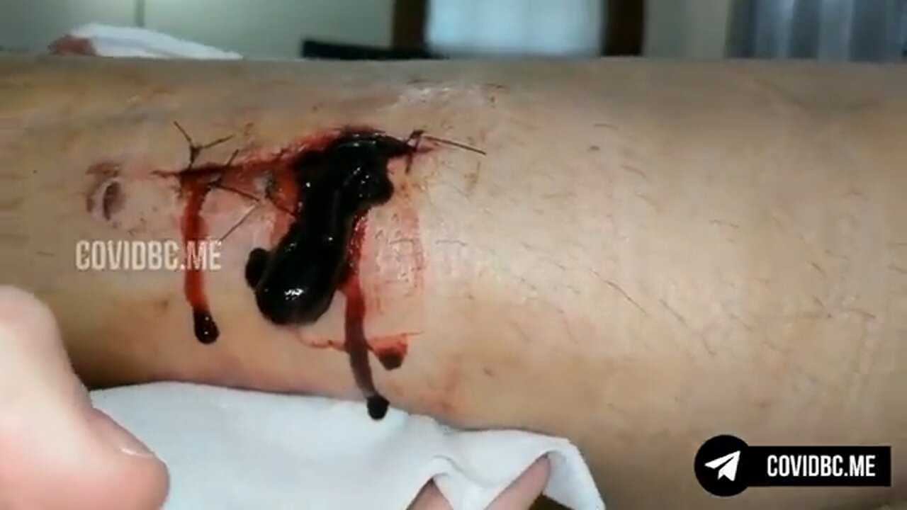 Fully vaxxed man comes home from surgery, where his wound opened up and started oozing huge clots.