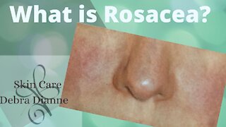 What is Rosacea?