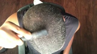 Inflamed Scalp Psoriasis Removal