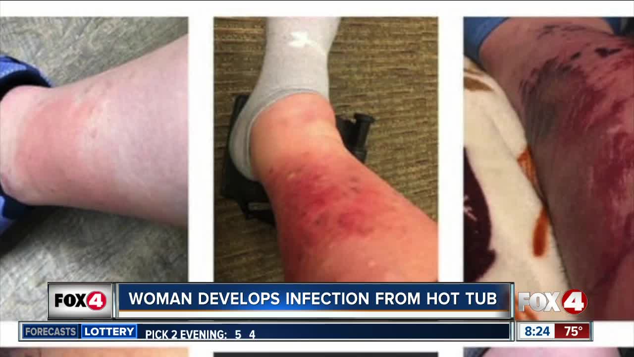 Hot tub causes infection on woman's legs