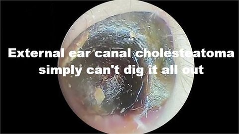 External ear canal cholesteatoma, simply can't dig it all out.