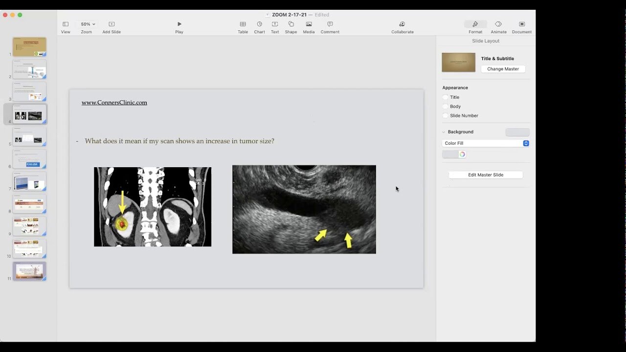 Radiation Therapy | What if my Tumor Increases? | Conners Clinic Zoom Call