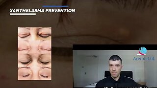 XANTHELASMA PREVENTION