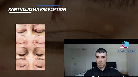 XANTHELASMA PREVENTION