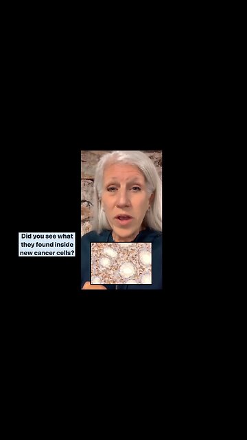 🚨Surprise,Surprise... they're Finding Spike Proteins From Jab Right in the MIDDLE OF CANCER CELLS - TURBO CANCER!