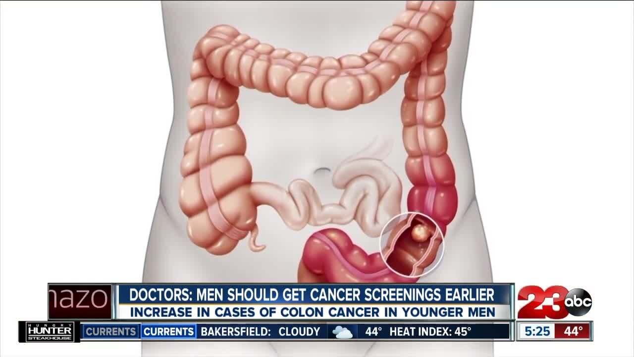 Doctors say men should get cancer screenings earlier, increase in cases of colon cancer in younger men