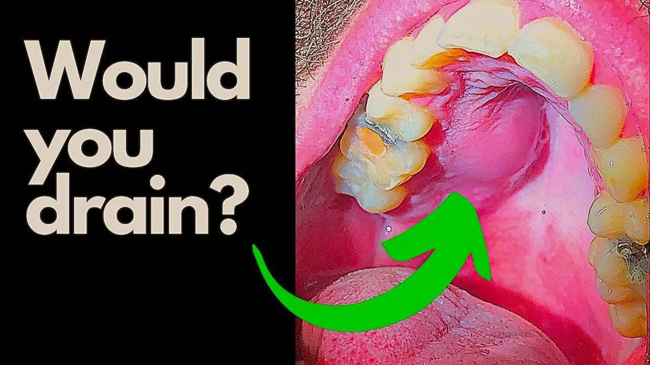 Tooth Abscess - Would you INCISE and Drain this Abcess?