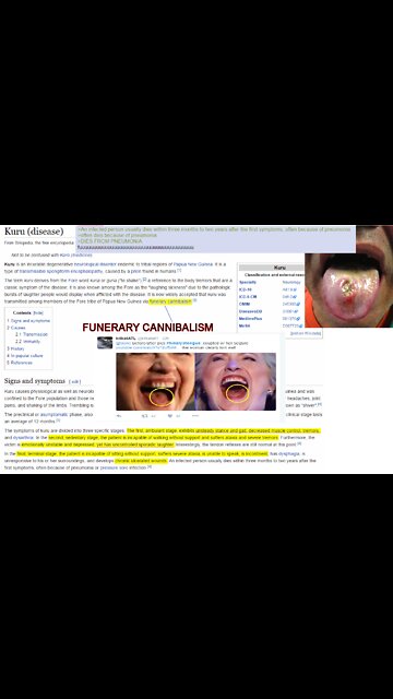 HITLERS DAUGHTER SUFFERING FROM KURIX DISEASE