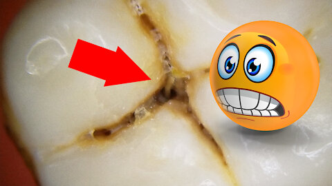 Why You Should Brush Your Teeth - Cavities Under the Microscope!