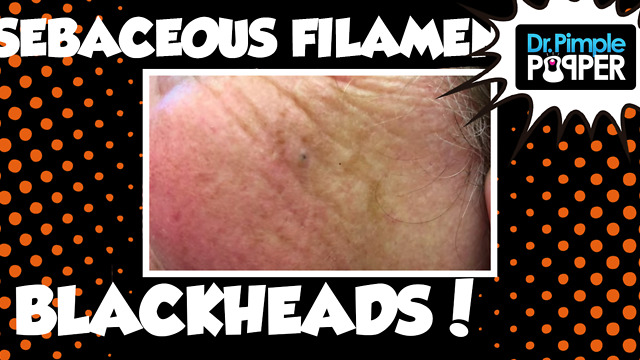 Two Women with Blackheads and Sebaceous Filaments