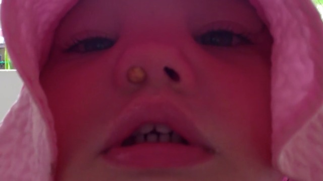 A Toddler Has A Peanut Stuck In Her Nose